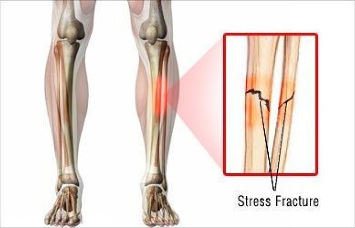 بالبلدي : علاج كسور الإجهاد.. وهذه النصائح قد تساعد في الوقاية