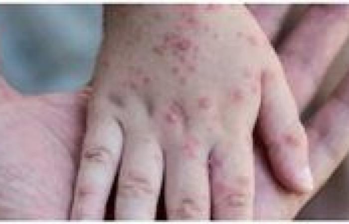 بالبلدي: India Reports Its First Case of Virulent Mpox Virus Strain